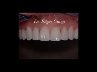 Carillas polimericas