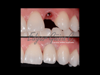 Rehabilitación del diente 22