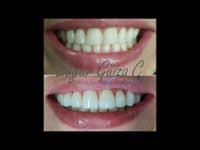 Diseño de Sonrisa –  Carillas Polimericas.