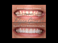 Caso de Bruxismo después de ortodoncia y carillas
