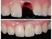 Paciente de corona sobreimplante