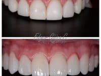 Paciente con carillas de resina y cambio a carillas de ceramica
