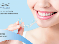 Ortodoncia – Alineadores transparentes