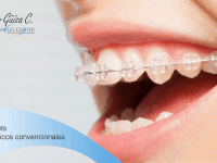 Brackets ceramicos convencionales