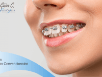 Brackets convencionales