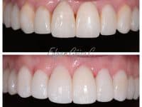 Carillas en ceramica