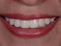 CARILLAS DE CERAMICA